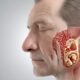 shingles and hearing loss