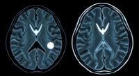 mri distinguishes acoustic neuroma