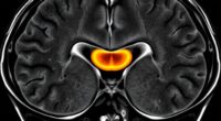 mri distinguishes acoustic tumors