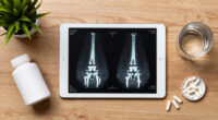 Osteopenia is silently weakening bones in millions of people